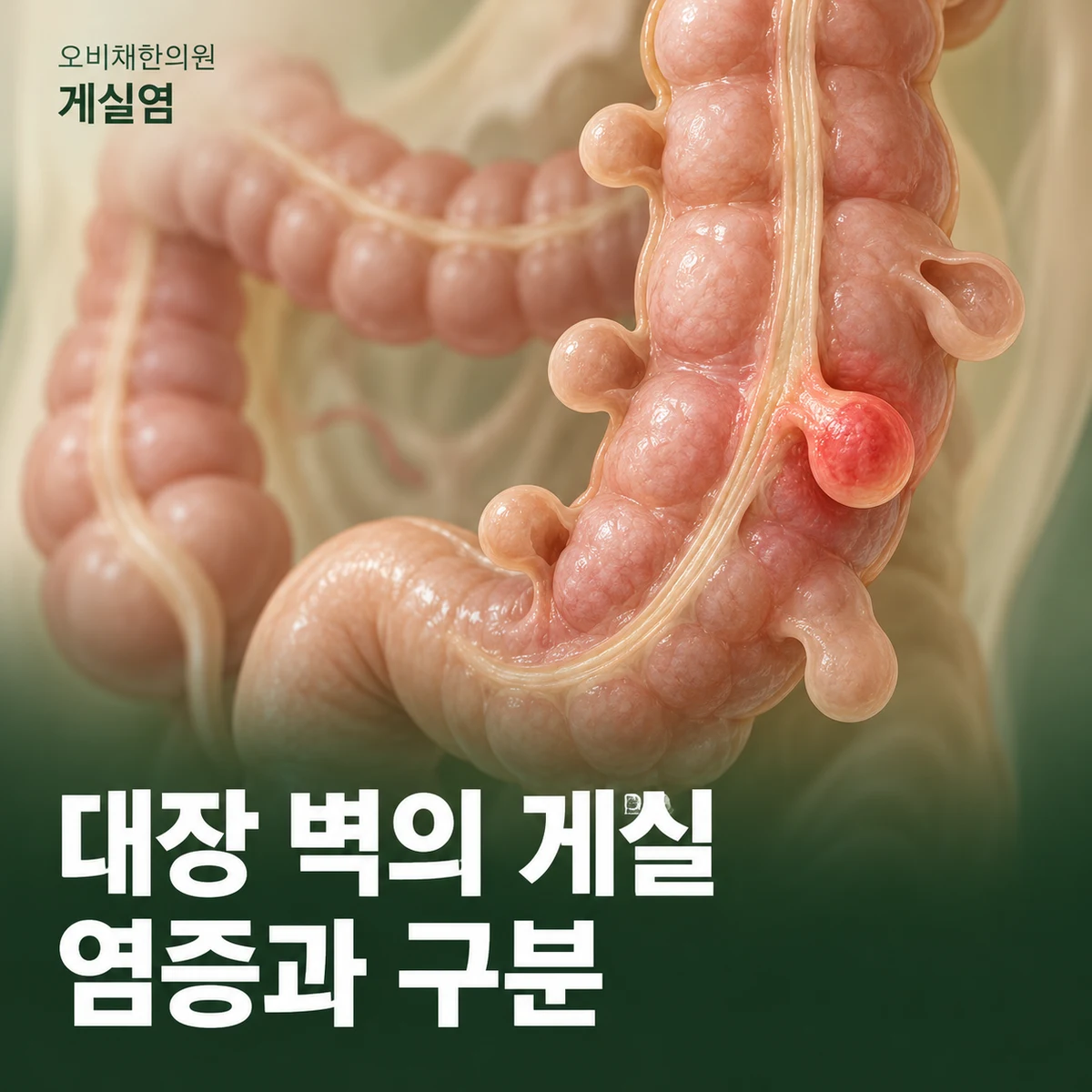 목동 게실염 원인과 구분 · 게실증과 염증의 차이