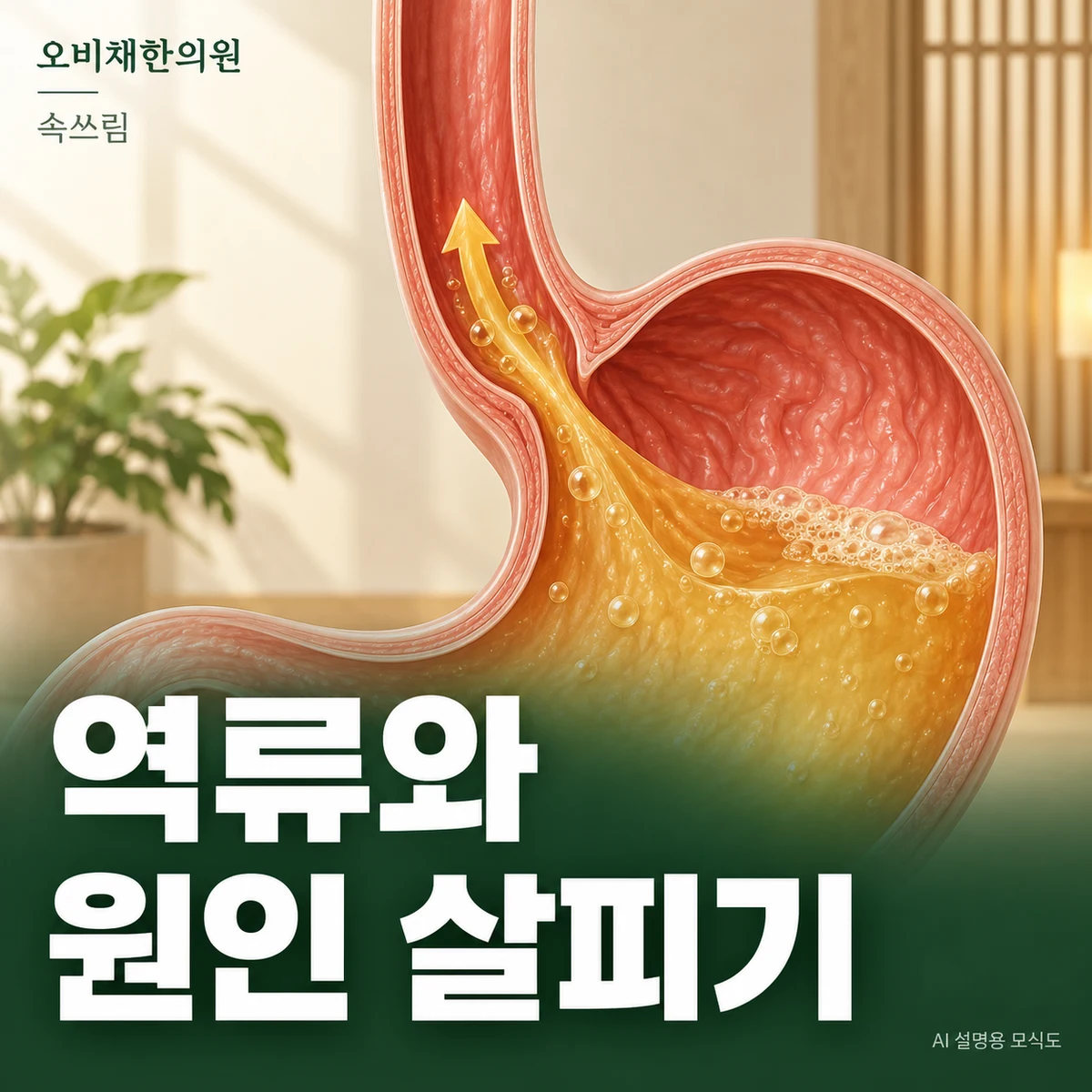 목동 속쓰림 원인과 구분 · 역류·약물·다른 원인