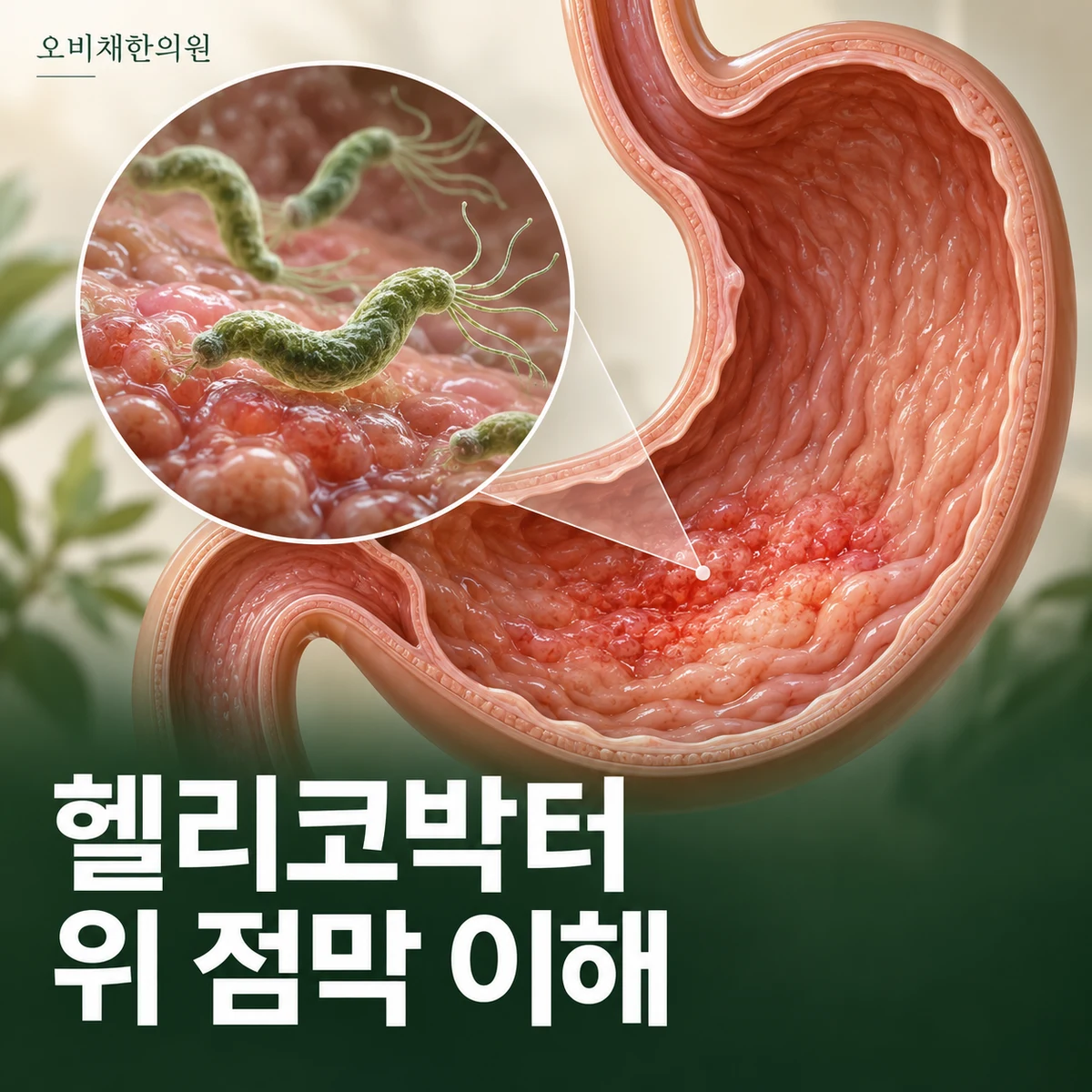 목동 헬리코박터 위염 원인과 구분 · 헬리코박터와 위 점막