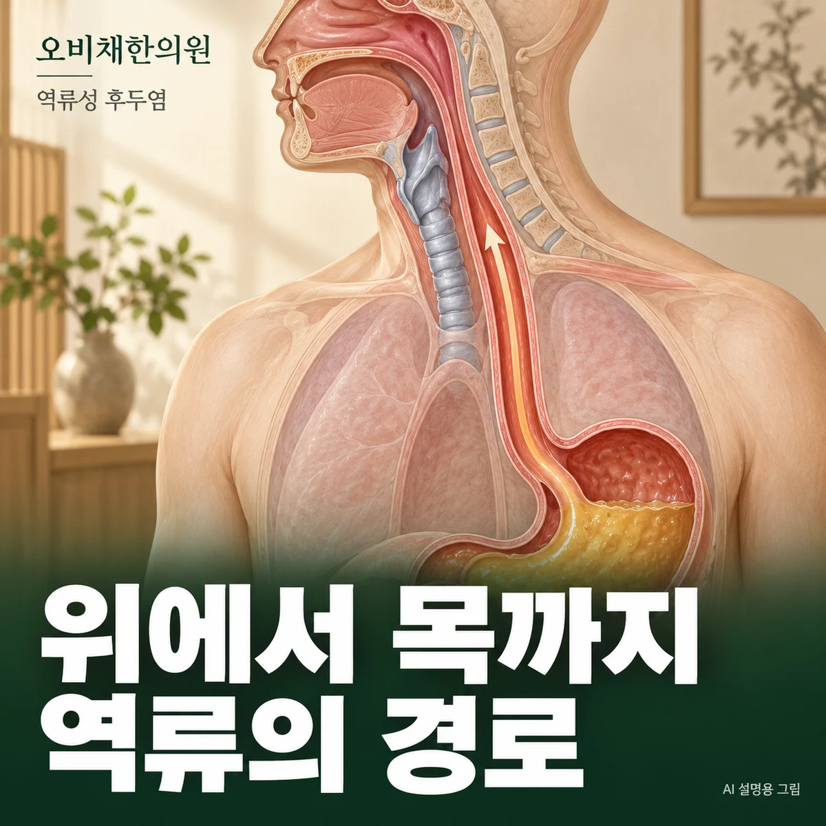 목동 역류성 후두염 원인과 구분 · 위·식도·인후두의 관계