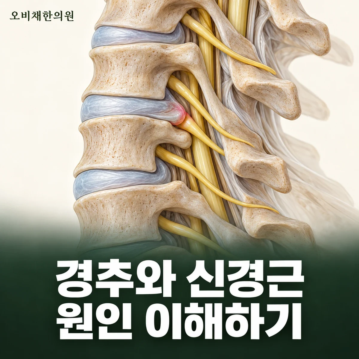 목동 경추성 팔통증 원인과 구분 · 경추 신경근과 팔의 연결