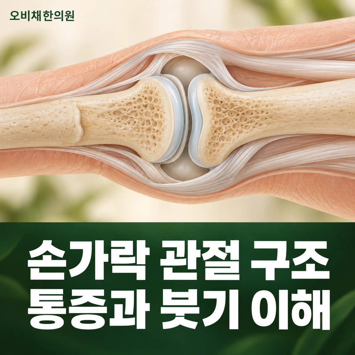 목동 손가락관절통증 원인과 구분 · 관절 변화와 염증