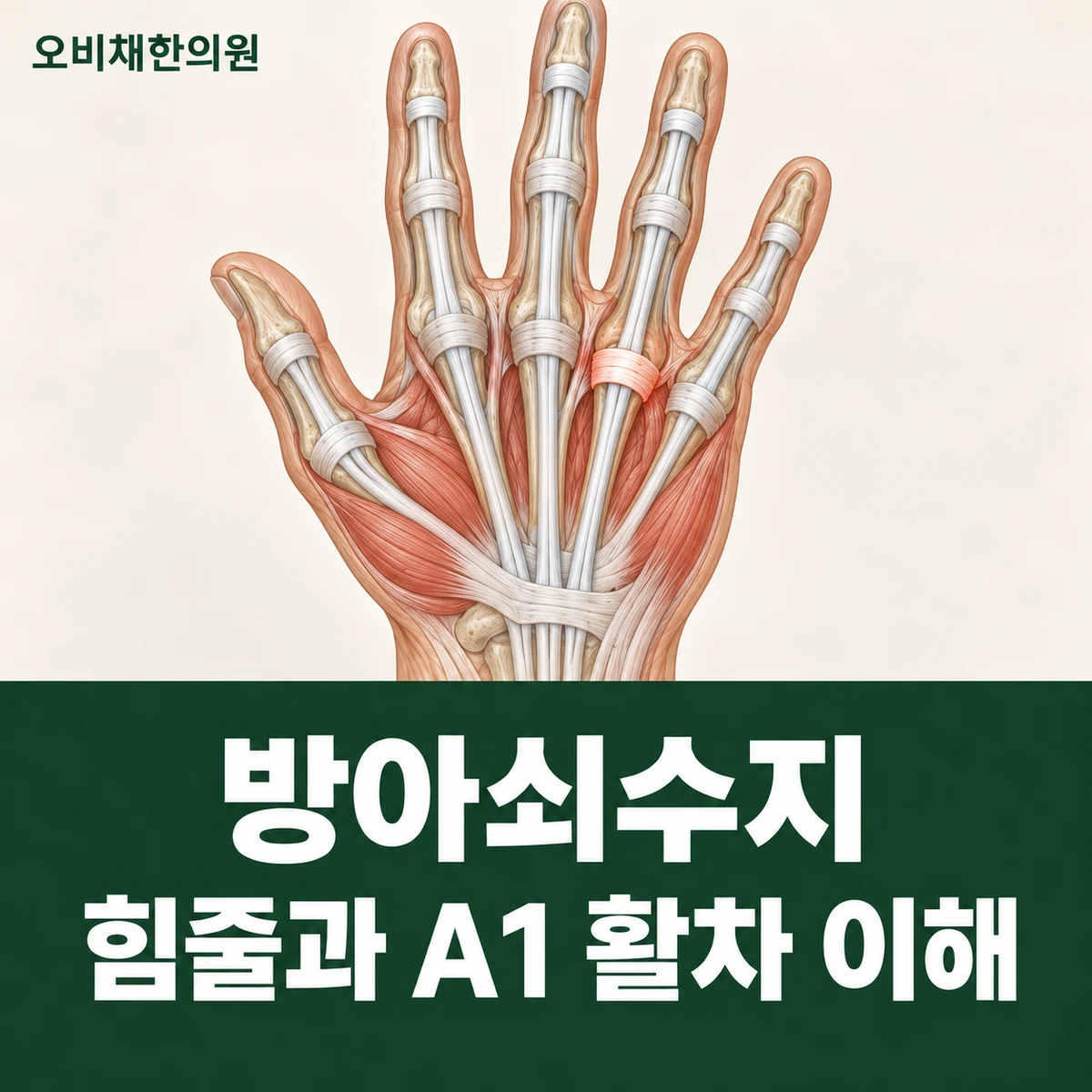 목동 방아쇠수지 원인과 구분 · 힘줄과 A1 활차 이해